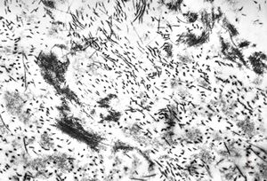 F, 62y. | myxoma atrii